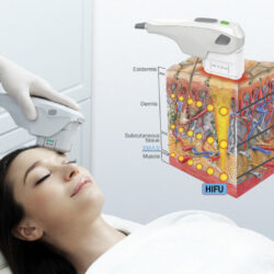 HIFU ultraheli lifting