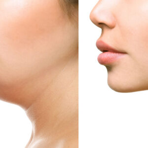 Krüolipolüüs näole