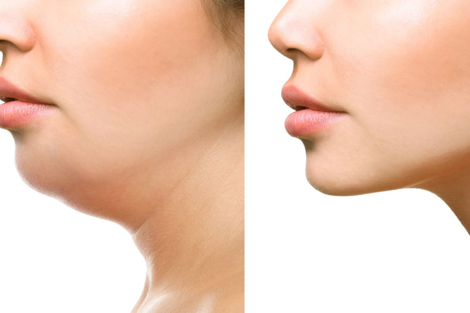 Krüolipolüüs Näole