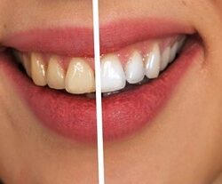 Hammaste Valgendamine